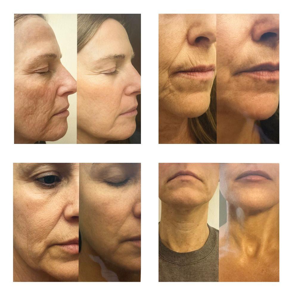 Micro infusion- Anti Rimpel Serum Systeem